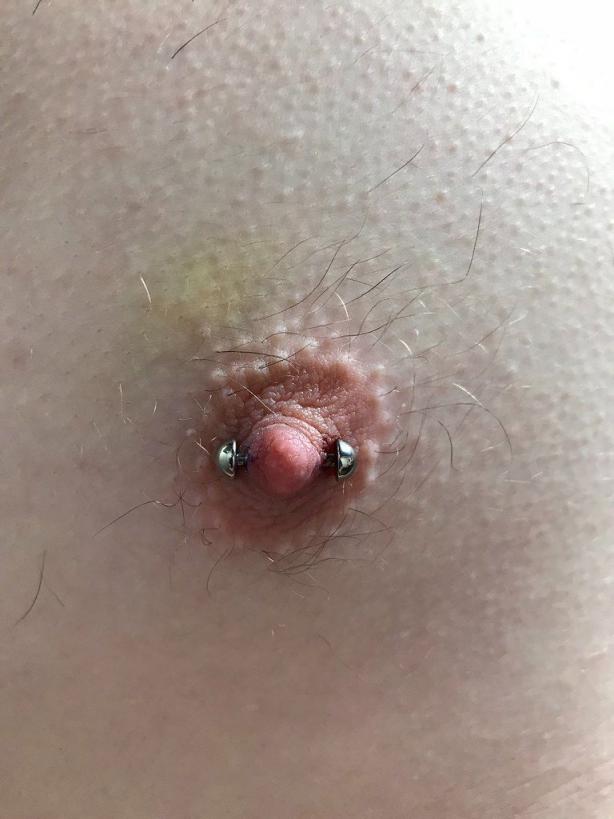 脐钉